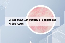 小孩银屑病吃中药出现副作用 儿童银屑病喝中药多久见效