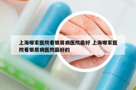 上海哪家医院看银屑病医院最好 上海哪家医院看银屑病医院最好的