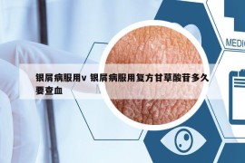 银屑病服用v 银屑病服用复方甘草酸苷多久要查血
