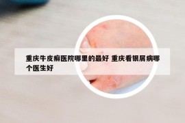 重庆牛皮癣医院哪里的最好 重庆看银屑病哪个医生好