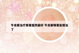 牛皮廨治疗那里医院最好 牛皮廨哪里能根治了