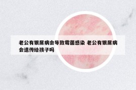老公有银屑病会导致霉菌感染 老公有银屑病会遗传给孩子吗