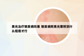 黑光治疗银屑病效果 银屑病照黑光要照到什么程度才行