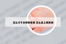 怎么才不会得银屑病 怎么患上银屑病