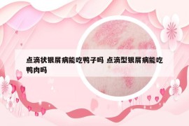 点滴状银屑病能吃鸭子吗 点滴型银屑病能吃鸭肉吗