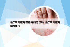治疗掌跖脓疱有最好的方法吗 治疗掌跖脓疱病的办法