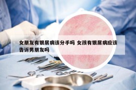 女朋友有银屑病该分手吗 女孩有银屑病应该告诉男朋友吗