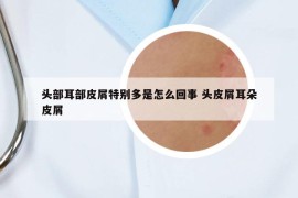 头部耳部皮屑特别多是怎么回事 头皮屑耳朵皮屑