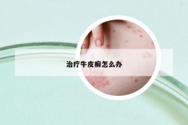治疗牛皮癣怎么办