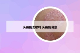 头癣能去根吗 头癣能自愈