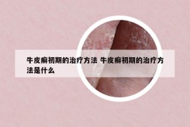 牛皮癣初期的治疗方法 牛皮癣初期的治疗方法是什么