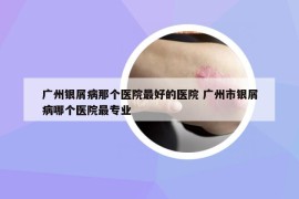 广州银屑病那个医院最好的医院 广州市银屑病哪个医院最专业