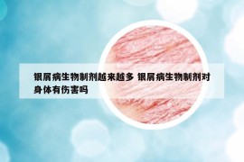 银屑病生物制剂越来越多 银屑病生物制剂对身体有伤害吗