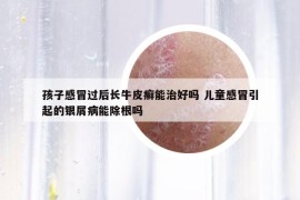 孩子感冒过后长牛皮癣能治好吗 儿童感冒引起的银屑病能除根吗