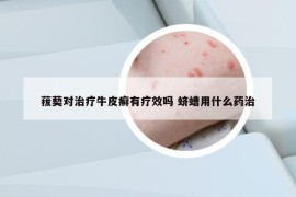 菝葜对治疗牛皮癣有疗效吗 蛴螬用什么药治