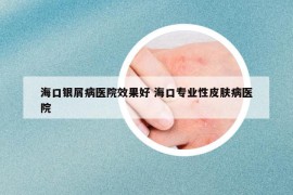 海口银屑病医院效果好 海口专业性皮肤病医院