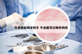牛皮癣能喝羊奶不 牛皮廨可以喝羊奶吗