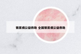 银屑病公益救助 全国银屑病公益救助