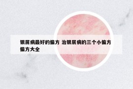 银屑病最好的偏方 治银屑病的三个小偏方 偏方大全