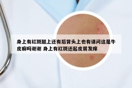 身上有红斑腿上还有后背头上也有请问这是牛皮癣吗谢谢 身上有红斑还起皮屑发痒