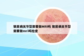 银屑病关节型需要做MRI吗 银屑病关节型需要做mri吗检查