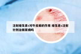 注射维生素c对牛皮癣的作用 维生素c注射针剂治银屑病吗