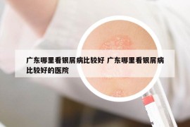 广东哪里看银屑病比较好 广东哪里看银屑病比较好的医院