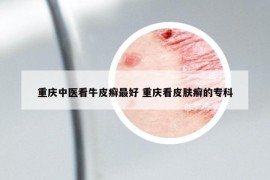 重庆中医看牛皮癣最好 重庆看皮肤癣的专科
