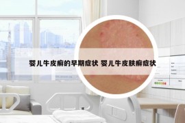 婴儿牛皮癣的早期症状 婴儿牛皮肤癣症状