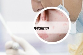 牛皮癣疗效