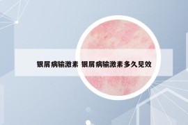 银屑病输激素 银屑病输激素多久见效