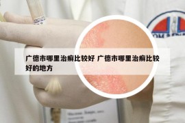 广德市哪里治癣比较好 广德市哪里治癣比较好的地方