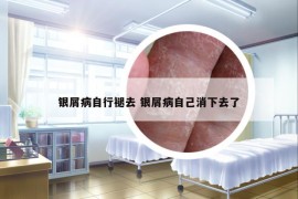 银屑病自行褪去 银屑病自己消下去了