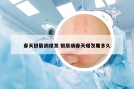 春天银屑病爆发 银屑病春天爆发期多久
