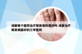 成都哪个医院治疗银屑病效果好吗 成都治疗银屑病最好的三甲医院
