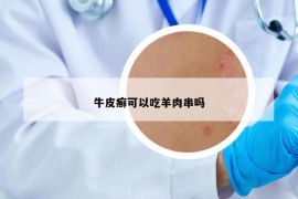牛皮癣可以吃羊肉串吗
