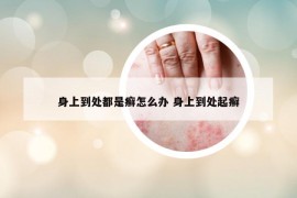 身上到处都是癣怎么办 身上到处起癣