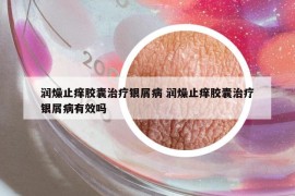 润燥止痒胶囊治疗银屑病 润燥止痒胶囊治疗银屑病有效吗
