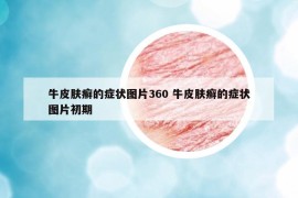 牛皮肤癣的症状图片360 牛皮肤癣的症状图片初期