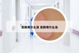 皮藓用什么涂 皮藓用什么治