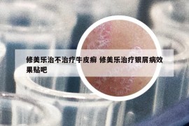 修美乐治不治疗牛皮癣 修美乐治疗银屑病效果贴吧