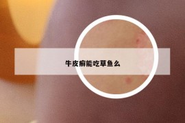 牛皮癣能吃草鱼么