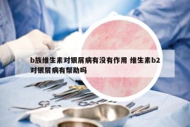b族维生素对银屑病有没有作用 维生素b2对银屑病有帮助吗