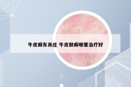 牛皮癣东肖庄 牛皮肤癣哪里治疗好