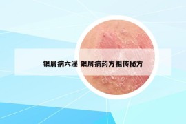 银屑病六淫 银屑病药方祖传秘方