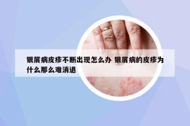 银屑病皮疹不断出现怎么办 银屑病的皮疹为什么那么难消退