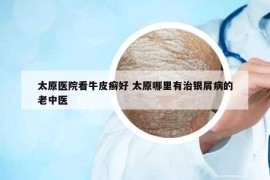 太原医院看牛皮癣好 太原哪里有治银屑病的老中医