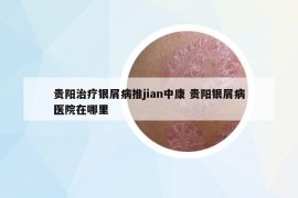 贵阳治疗银屑病推jian中康 贵阳银屑病医院在哪里