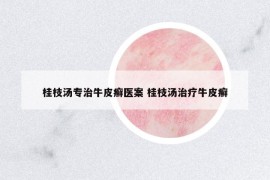桂枝汤专治牛皮癣医案 桂枝汤治疗牛皮癣