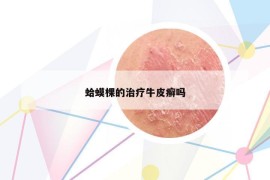 蛤蟆棵的治疗牛皮癣吗